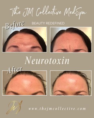 Botox - Before & After - Look at this beautiful refresh!
This client wanted to soften fine lines while keeping her natural expression—and we delivered. Botox isn’t about looking frozen; it’s about subtle, refined enhancement that lets your natural beauty shine through.
It’s all about balance: smoother skin, softened lines, and a refreshed, radiant look—without sacrificing movement or expression.
Thinking about trying Botox? Let’s talk. Send a DM to book your private consultation today. Botox - Before & After - Look at this beautiful refresh!
This client wanted to soften fine lines while keeping her natural expression—and we delivered. Botox isn’t about looking frozen; it’s about subtle, refined enhancement that lets your natural beauty shine through.
It’s all about balance: smoother skin, softened lines, and a refreshed, radiant look—without sacrificing movement or expression.
Thinking about trying Botox? Let’s talk. Send a DM to book your private consultation today.