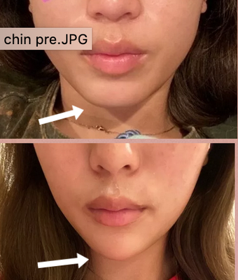 Nasolabial/smile Lines Filler - Chin Filler and full face filler Nasolabial/smile Lines Filler - Chin Filler and full face filler