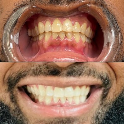 Teeth Whitening - LED Teethe Whitening is the process of using a teeth whitening solution combined with LED light to whiten teeth. Session start at 30 minutes.