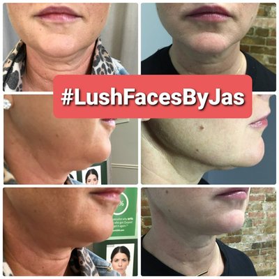 Kybella Treatment - Get rid of the submental fullness aka "Turkey Neck" with us today! 🦃
Here is one of our own beautiful patients who received only 1 treatment of Kybella and already you can see the decrease in fullness and that beautiful contoured jawline coming out!😍🔥
These results are permanent!!!😲
Call today to set up your FREE consultation with Georgetown's own Master Aesthetics Injector, Jasmin Wheeler, APRN, FNP-C.
☎️859-629-0987
⌨Lushaestheticsky@gmail.com
💻www.lushaestheticsky.com
📲Or book online at lush.myaestheticrecord.com
20w Kybella Treatment - Get rid of the submental fullness aka "Turkey Neck" with us today! 🦃
Here is one of our own beautiful patients who received only 1 treatment of Kybella and already you can see the decrease in fullness and that beautiful contoured jawline coming out!😍🔥
These results are permanent!!!😲
Call today to set up your FREE consultation with Georgetown's own Master Aesthetics Injector, Jasmin Wheeler, APRN, FNP-C.
☎️859-629-0987
⌨Lushaestheticsky@gmail.com
💻www.lushaestheticsky.com
📲Or book online at lush.myaestheticrecord.com
20w