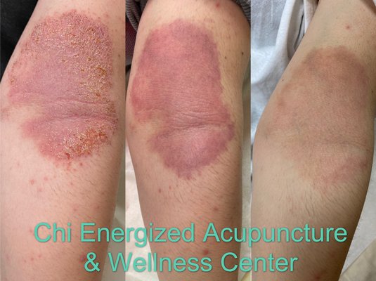 Acupuncture plus Herbal Supplement to treating eczema - Our SPECIALTIES are in treating Skin Diseases, Immune Disorders, Women’s health, Bell’s Palsy, Headache, Severe & Chronic Pain, Facial Rejuvenation and Weight Loss.
Especially have had many successful in treating eczema and acne issues.