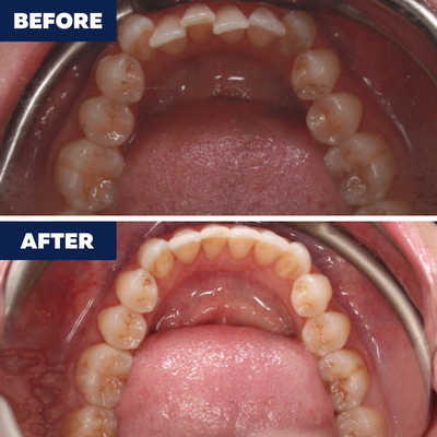 Spacing/Crowding Correction - Orthodontic Treatment - See how braces and Invisalign® can close gaps, straighten crowded teeth, and create beautifully aligned smiles. Whether you’re dealing with too much space or not enough, our customized orthodontic treatments deliver lasting results and renewed confidence.
✨ Start your journey to a perfectly balanced smile — book your free consultation today! Spacing/Crowding Correction - Orthodontic Treatment - See how braces and Invisalign® can close gaps, straighten crowded teeth, and create beautifully aligned smiles. Whether you’re dealing with too much space or not enough, our customized orthodontic treatments deliver lasting results and renewed confidence.
✨ Start your journey to a perfectly balanced smile — book your free consultation today!