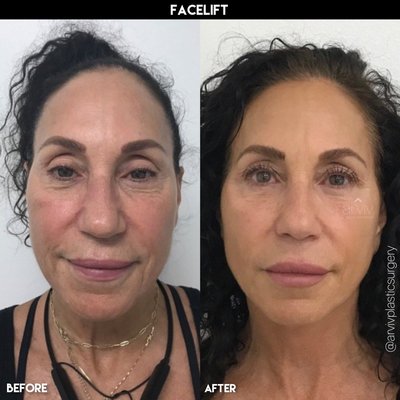 FACELIFT - This client wanted a more youthful appearance and to rid her face of sagging skin and wrinkles.