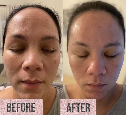 Microneedling - Microneedling is a medical grade service used to create micro pores into the skin. By creating these pores the skin promotes collagen regeneration, which is part of the healing cascade. This also allows for creams and serums to be better absorbed into the skin. Different serums can be used and combined depending on the patient’s skin problems/condition. There is minimal discomfort during the procedure. The face is numbed with lidocaine cream prior to starting. There is very little downtime afterwards. After the procedure, it is highly recommended to avoid the sun and always use sunscreen as exposure to the sun can cause hyperpigmentation. Microneedling should be done every 4-6 weeks. It can also be combined with the patient’s own blood or PRP/PRF to enhance effects. Microneedling - Microneedling is a medical grade service used to create micro pores into the skin. By creating these pores the skin promotes collagen regeneration, which is part of the healing cascade. This also allows for creams and serums to be better absorbed into the skin. Different serums can be used and combined depending on the patient’s skin problems/condition. There is minimal discomfort during the procedure. The face is numbed with lidocaine cream prior to starting. There is very little downtime afterwards. After the procedure, it is highly recommended to avoid the sun and always use sunscreen as exposure to the sun can cause hyperpigmentation. Microneedling should be done every 4-6 weeks. It can also be combined with the patient’s own blood or PRP/PRF to enhance effects.