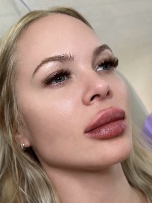 Injectables - Botox
Jueveau
Lip filler Injectables - Botox
Jueveau
Lip filler