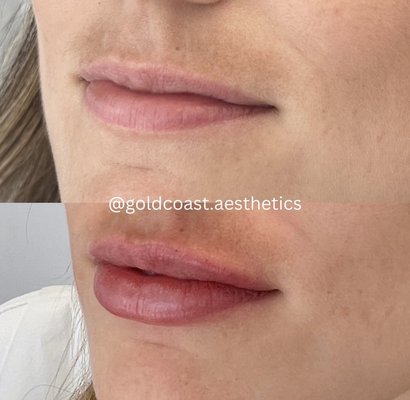 Lip Filler - Here is a collection of some of our stunning lip filler patients' before & afters! Lip Filler - Here is a collection of some of our stunning lip filler patients' before & afters!