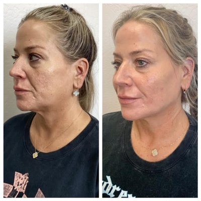 The" liquid facelift" - This woman was able to restore lost facial volume and achieve a stronger jawline contour with several syringes of Jueverderm filler.