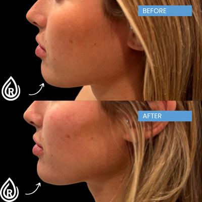 Filler - At Refresh Medical, we offer the full RHA® Collection—the latest in FDA-approved dermal fillers built for the most expressive areas of your face. Our expert medical team tailors every treatment with RHA Redensity, RHA 2, RHA 3, and RHA 4 to smooth lines, restore volume, and enhance natural contours. RHA fillers move seamlessly with your facial expressions, delivering beautiful, natural-looking results—never stiff or overdone. Trust Refresh for safe, effective, and personalized care that leaves you looking and feeling your best, both at rest and in motion. Filler - At Refresh Medical, we offer the full RHA® Collection—the latest in FDA-approved dermal fillers built for the most expressive areas of your face. Our expert medical team tailors every treatment with RHA Redensity, RHA 2, RHA 3, and RHA 4 to smooth lines, restore volume, and enhance natural contours. RHA fillers move seamlessly with your facial expressions, delivering beautiful, natural-looking results—never stiff or overdone. Trust Refresh for safe, effective, and personalized care that leaves you looking and feeling your best, both at rest and in motion.