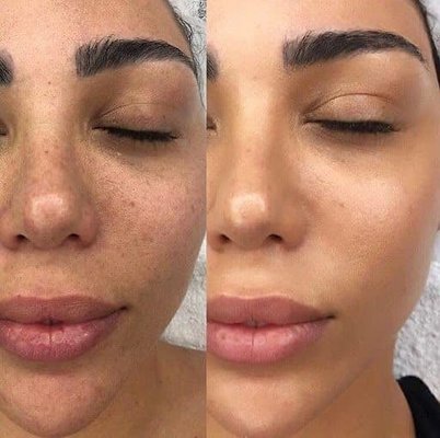 Hydrating Facials - Free Consultations