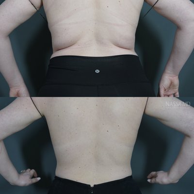 Body Sculpting - Before and After photos from Coolsculpting, ThermiSmooth & More Body Sculpting - Before and After photos from Coolsculpting, ThermiSmooth & More