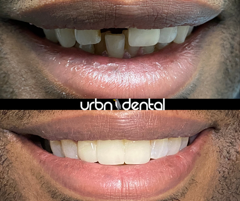 Making Patients Smile : ) - As one of the top-rated dentist in Houston, URBN Dental Houston provides a variety of dental services, including Invisalign®, dental implants, general dentistry, cosmetic dentistry, restorative and preventive care.
In addition to being one of the cosmetic dentists of Houston, we are an emergency dental office that takes same-day emergency dental appointments for immediate treatment. Our emergency dentists will make sure that you receive the excellent dental care that you deserve. Making Patients Smile : ) - As one of the top-rated dentist in Houston, URBN Dental Houston provides a variety of dental services, including Invisalign®, dental implants, general dentistry, cosmetic dentistry, restorative and preventive care.
In addition to being one of the cosmetic dentists of Houston, we are an emergency dental office that takes same-day emergency dental appointments for immediate treatment. Our emergency dentists will make sure that you receive the excellent dental care that you deserve.