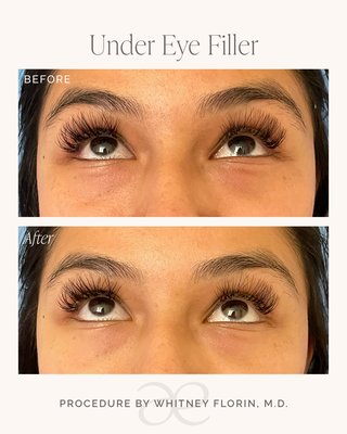 Under Eye Rejuvenation - The delicate under-eye area is often one of the first places to show signs of aging, with hollowness, dark circles, fine lines, and skin laxity contributing to a tired appearance. Because these concerns rarely have a single cause, the best results often come from a personalized combination of treatments rather than filler alone.
Depending on your anatomy and goals, your treatment plan may include dermal filler to restore volume, PRF to improve skin quality, laser resurfacing to soften fine lines and tighten the skin, and medical-grade skincare to support long-term results. By addressing both volume loss and skin health, we create brighter, smoother, more refreshed eyes while maintaining a natural appearance. Under Eye Rejuvenation - The delicate under-eye area is often one of the first places to show signs of aging, with hollowness, dark circles, fine lines, and skin laxity contributing to a tired appearance. Because these concerns rarely have a single cause, the best results often come from a personalized combination of treatments rather than filler alone.
Depending on your anatomy and goals, your treatment plan may include dermal filler to restore volume, PRF to improve skin quality, laser resurfacing to soften fine lines and tighten the skin, and medical-grade skincare to support long-term results. By addressing both volume loss and skin health, we create brighter, smoother, more refreshed eyes while maintaining a natural appearance.