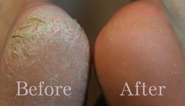 Heel Cracking - See The Before And After Pictures of Some of Our Services At Our Clinic. Heel Cracking, Bunions, Hammertoes, Fungal Toe Nails, Foot and Ankle Pain/Swelling