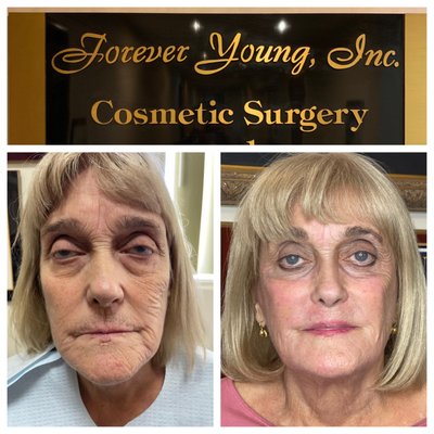 Fillers - We have 10 different types of fillers, such as Restylane , Juvederm, Radiesse, sculptra , and Bellafill. Some of these fillers only last six months to a year others are permanent. We tailor the filler to our patients needs without making them look done. Fillers - We have 10 different types of fillers, such as Restylane , Juvederm, Radiesse, sculptra , and Bellafill. Some of these fillers only last six months to a year others are permanent. We tailor the filler to our patients needs without making them look done.