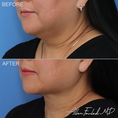 Isolated Full Neck Lift - An isolated full neck lift can be performed without including the upper portion of a facelift when the only concern is the shape and appearance of the neck (and excess skin at the neck exists), but there are no existing issues with the lower face (such as sagging of the jowls or jawline).