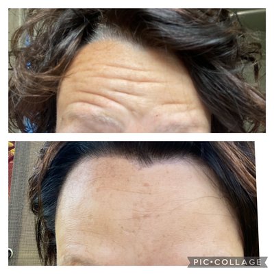 Forehead lines pre and post treatment with Cosmetic Botox - Here is an example of ho cosmetic Botox can work for you. The top photo was taken prior to treatment with Cosmetic Botox. The bottom photo was taken 14 days post treatment. Forehead lines pre and post treatment with Cosmetic Botox - Here is an example of ho cosmetic Botox can work for you. The top photo was taken prior to treatment with Cosmetic Botox. The bottom photo was taken 14 days post treatment.
