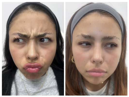 Natural Facial transformation with Botox and fillers - Neuromodulators like Botox and dermal fillers were used to enhance various parts of the face to give more facial balancing and refined look  Natural Facial transformation with Botox and fillers - Neuromodulators like Botox and dermal fillers were used to enhance various parts of the face to give more facial balancing and refined look 