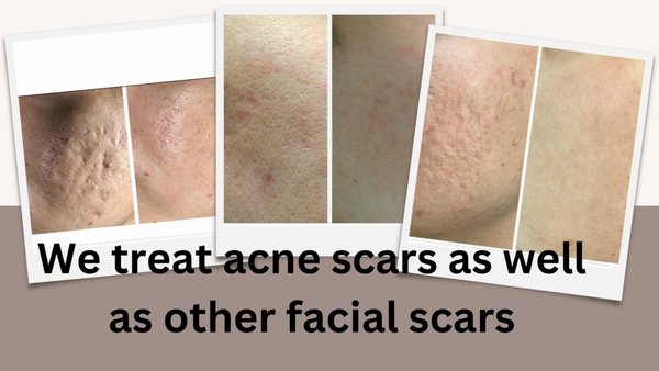 Acne & Facial Scars - We treat acne scars as well as other facial scars Acne & Facial Scars - We treat acne scars as well as other facial scars