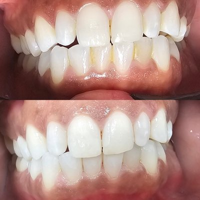 teeth whitening - whitening done in 16 minutes! we can enhance your smile without causing sensitivity teeth whitening - whitening done in 16 minutes! we can enhance your smile without causing sensitivity