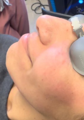 CO2 Laser "cool peel" - This patient came to us looking to have some moles removed. We were able to complete this treatment in one visit using our Cool Peel CO2 laser.