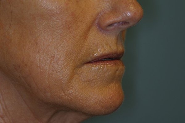 Lip Augmentation - This lovely female patient was concerned that her lips were thinning and had peri-oral wrinkles that appeared aged. Over time, we experience loss of volume and sun exposure in this part of the state can have adverse aging signs on the skin. She desired to have subtle improvement in volume, restoration of her lip anatomy and minimize the appearance of wrinkles. 1cc of hyaluronic acid filler was injected under local anesthesia to ensure a painless experience. This 10 minute procedure resulted in a very happy patient.