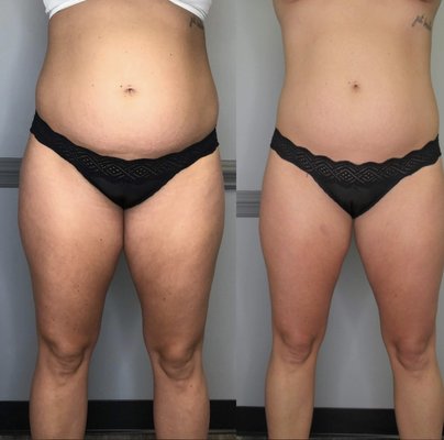 Cryo-Sculpting - A targeted cryo-contouring treatment for one large area or two medium areas. This session helps reduce inflammation, tighten the skin, and encourage natural shaping. Perfect for clients wanting a noticeable refresh or to begin their sculpting journey.