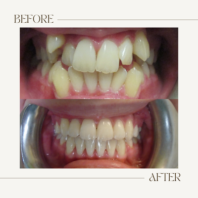 Before & After - Patient treated in 20 months Before & After - Patient treated in 20 months