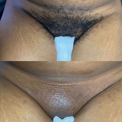 Brazilian Wax - This service removes all hair from the vagina area and butt strip .