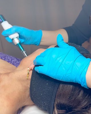 Microneedling - This was a 6 session Microneedling Client, that had great results. Microneedling - This was a 6 session Microneedling Client, that had great results.
