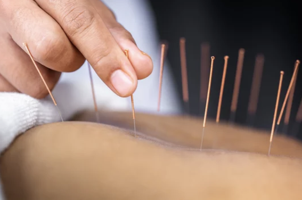 Our Services! - Acupuncture:
Acupuncture is done by inserting very thin needles at very precise acupuncture points to promote natural healing.

Acupressure:
Acupressure is done by pressing on very precise acupuncture points or meridians to promote natural healing. It is a great way to start experiencing the benefits of acupuncture. 

Cupping:
Cupping involves placing cups on the skin to create suction. This practice dates back over 2,000 years but has received recent attention in the media due to its use by world-class athletes for injury relief.

Moxibustion:
Moxibustion consists of burning dried mugwort on particular points on the body.

Herbs:
Chinese herbal medicine utilizes thousands of medicinal substances—primarily plants, but also some minerals and animal products to promote health. We only select the highest quality herbal formulas which are free of heavy metals and bio-contaminants.

Tuina:
Tuina is a therapeutic form of massage and bodywork which has been used in China for more than 5,000 years.