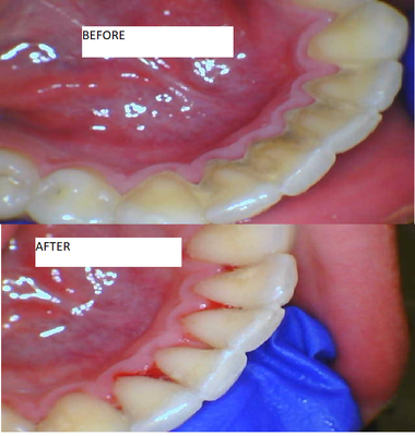 Prophylaxis Cleaning - Prophylaxis Adult - is a cleaning procedure to clean patient's teeth. This helps keep teeth / gums healthy and clean. Recommended twice per year! Prophylaxis Cleaning - Prophylaxis Adult - is a cleaning procedure to clean patient's teeth. This helps keep teeth / gums healthy and clean. Recommended twice per year!