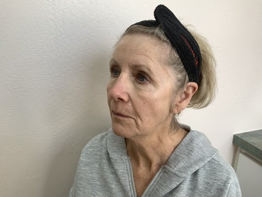 Refresh appearance - This beauty refreshed her skin with three opus plasma treatments and received three syringes of dermal filler to restore lost volume.