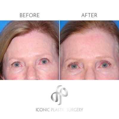 Blepharoplasty - Eyelid Surgery - Blepharoplasty before and after photos. Blepharoplasty - Eyelid Surgery - Blepharoplasty before and after photos.
