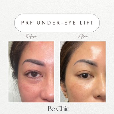 PRF Under-Eye - BPRF Under-Eye Treatment
A natural, regenerative solution that uses your own platelet-rich fibrin to reduce dark circles, fine lines, and hollowing—leaving the under-eye area smoother, brighter, and more refreshed with minimal downtime. PRF Under-Eye - BPRF Under-Eye Treatment
A natural, regenerative solution that uses your own platelet-rich fibrin to reduce dark circles, fine lines, and hollowing—leaving the under-eye area smoother, brighter, and more refreshed with minimal downtime.