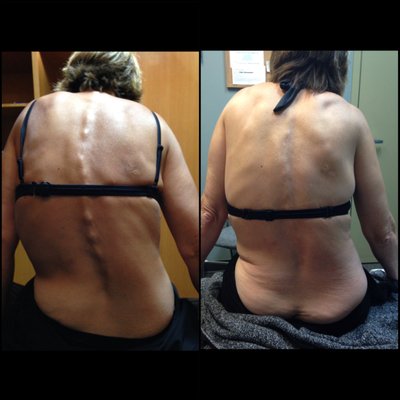 Functional Scoliosis due to MS - Functional Scoliosis due to multiple sclerosis treated with True Shockwave Therapy at Unpain Clinic! Functional Scoliosis due to MS - Functional Scoliosis due to multiple sclerosis treated with True Shockwave Therapy at Unpain Clinic!