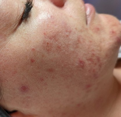 Monthly Hydrafacials and Skin Better Science Chemical Peels - This lovely lady has been coming to see us on a monthly basis since July of 2022 for monthly Deluxe Hydrafacials to clear out pores and increase hydration levels.  Her main concern is acne and acne scarring. In June of this year she started using Skin better Science home care, and have since done 2 chemical peels to start addressing underlying redness and pigmentation. We also plan to target scarring with SkinPen Microneedling and some laser facials for vascularity in the surface of her skin as well as to regulate oil gland secretions.