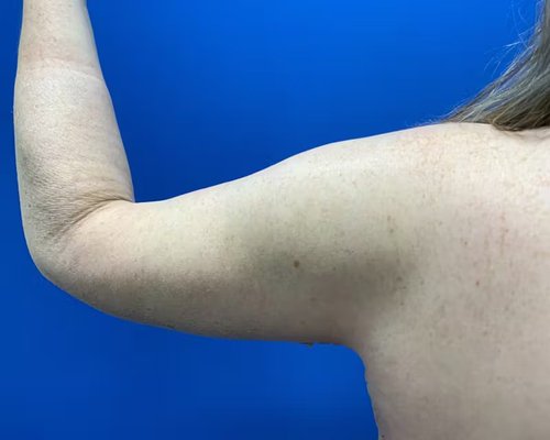 Arm Lift - Arm lift performed by Dr. Gavin Dry. Patient was age 52, female, and final images were captured at 1 month post-op. Arm Lift - Arm lift performed by Dr. Gavin Dry. Patient was age 52, female, and final images were captured at 1 month post-op.