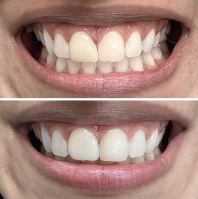 Crowns - Crown cases at Fuller Smiles