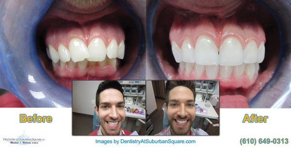 Invisalign® Smile Transformations - Every smile is unique, and every Invisalign® treatment plan is customized to the patient's goals. Dr. Michael Wollock has helped thousands of patients achieve healthier, more confident smiles using advanced Invisalign treatment planning. Browse these real before-and-after cases to see what's possible with expert care and experience. Invisalign® Smile Transformations - Every smile is unique, and every Invisalign® treatment plan is customized to the patient's goals. Dr. Michael Wollock has helped thousands of patients achieve healthier, more confident smiles using advanced Invisalign treatment planning. Browse these real before-and-after cases to see what's possible with expert care and experience.
