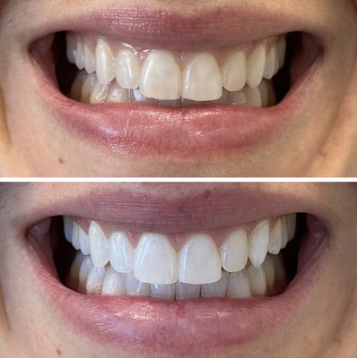 Teeth Whitening - Teeth Whitening cases