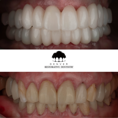 Implant Supported Bridge - 🦷 Implant-Supported Bridge 🦷
This patient came to us with all her prior crowns decayed. To help her achieve a healthier and more comfortable smile, an FP1 style implant supported bridge was produced and placed on her uppers and lowers. These implant-supported bridges are a slim, comfortable prosthetic with minimal bulk that are also less invasive and conservative. 🦷

 It was an incredible transformation for this patient and her smile by taking her teeth from decaying and damaged to new and healthy. 💪