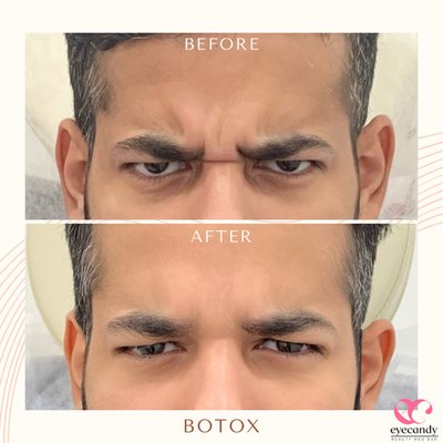 BOTOX - Wrinkles no more!
Get rid of unsightly wrinkles! Make yourself look 10 years younger with our Botox procedure. Reduce fine lines, tighten saggy skin, lift your brows and eyes, stop underarm sweating, and many more!
Text 📲: (949)-877-0256
Call 📞: (562)-402-1888
Website 💻: www.eyecandylashandbrowspa.com