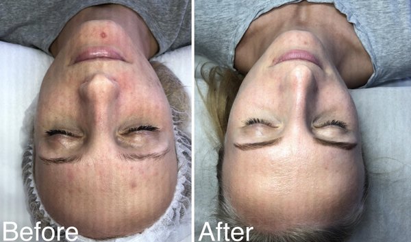 Microneedling - Brows are one of the most important face beauty elements. Symmetric, properly shaped to your complexion brows can instantly elevate your natural look. AskCares offers microneedling services that look natural and will let you wake up looking your best every day! Microneedling - Brows are one of the most important face beauty elements. Symmetric, properly shaped to your complexion brows can instantly elevate your natural look. AskCares offers microneedling services that look natural and will let you wake up looking your best every day!
