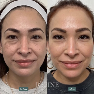 Results | Dermal/Facial Fillers - Injectables are popular for a reason. They’re safe procedures that are easy to recover from and produce instant results that can last months to years.  Injectables are minimally invasive, unlike expensive surgical procedures, and you’ll be in and out of the office in no time at all.
Refine Aesthetics is an Austin Med Spa that offers numerous different kinds of fillers, from hyaluronic acid-based fillers to biostimulators,  so you can enjoy a rejuvenated, more youthful appearance.