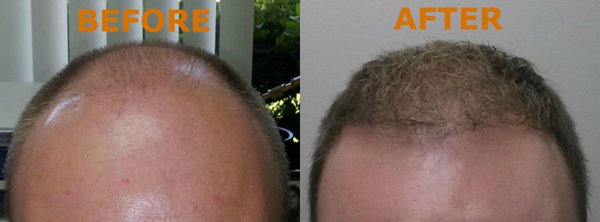 Hair Transplant Neo Graft - What is a FUE Hair Transplant?
FUE (follicular unit extraction) is a minimally invasive hair transplant procedure that involves harvesting hair follicles from the back of the patient’s scalp, using automated and robotic devices that DO NOT LEAVE a linear scar and then placing them into areas where the hair is thinning.
Hair loss is an unwanted effect of aging, genetics, or health conditions, and most want to do whatever possible to restore their identity. FUE hair restoration is an innovative procedure that reclaims your thick, healthy hair and boosts confidence.
Follicular Unit Extraction (“FUE”) process is quite different because it involves no scalpel, no stitches or staples, and fast healing.
Instead of making a large incision in your scalp, the process uses a low-impact, precision tool under high powered magnification, to harvest each hair follicle individually
Each individual hair is then transplanted in the exact way, direction, and angle your hair grows, making your restoration look and feel totally natural.
Not only does FUE process give you more natural-looking results with faster healing times and no scars, but follicle survival rates also far exceed other methods allowing us to give you the extra assurance of a Growth Guarantee. Hair Transplant Neo Graft - What is a FUE Hair Transplant?
FUE (follicular unit extraction) is a minimally invasive hair transplant procedure that involves harvesting hair follicles from the back of the patient’s scalp, using automated and robotic devices that DO NOT LEAVE a linear scar and then placing them into areas where the hair is thinning.
Hair loss is an unwanted effect of aging, genetics, or health conditions, and most want to do whatever possible to restore their identity. FUE hair restoration is an innovative procedure that reclaims your thick, healthy hair and boosts confidence.
Follicular Unit Extraction (“FUE”) process is quite different because it involves no scalpel, no stitches or staples, and fast healing.
Instead of making a large incision in your scalp, the process uses a low-impact, precision tool under high powered magnification, to harvest each hair follicle individually
Each individual hair is then transplanted in the exact way, direction, and angle your hair grows, making your restoration look and feel totally natural.
Not only does FUE process give you more natural-looking results with faster healing times and no scars, but follicle survival rates also far exceed other methods allowing us to give you the extra assurance of a Growth Guarantee.