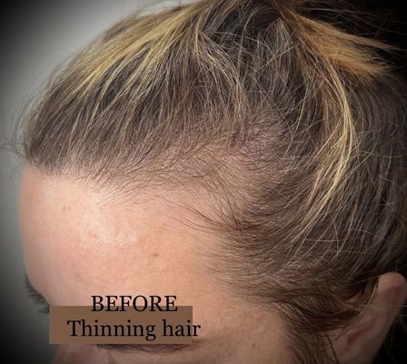 Scalp Micropigmentation for Woman - Before & After Scalp Micropigmentation treatments for Woman Scalp Micropigmentation for Woman - Before & After Scalp Micropigmentation treatments for Woman