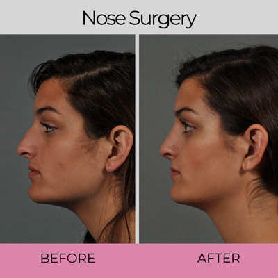 Nose Surgery - Restore A Youthful & Self-Assured Appearance!
Our goal is to create a discreet, caring environment where you feel safe to honestly express your wishes and receive highly personalized options that will achieve your aesthetic goals. With over 25 years of experience, Dr. Hall’s approach to patients is to treat each one as an individual and commit the time and effort to do what is best for them.