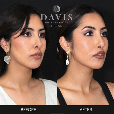 Rhinoplasty - Before and After images of Dr. Davis' Rhinoplasty work.
