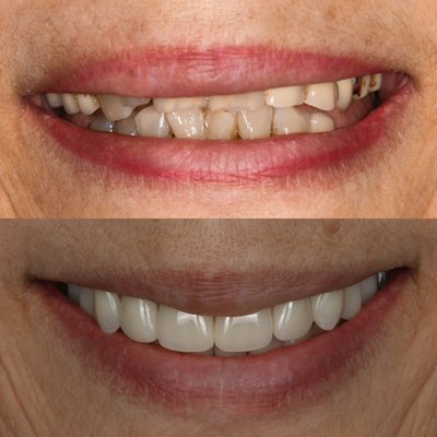 Full Dental Implants/All on 4 - Patients can have failing or missing teeth that can cause functional and cosmetic issues. Dental implants can be used to replace several to all of her missing teeth.