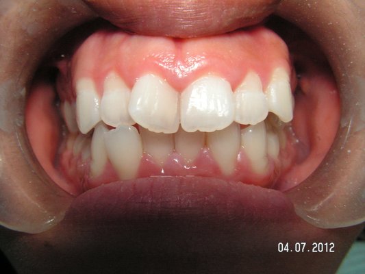 Invisalign Portfolio - 33yr old female embarrassed about her teeth so she doesn't like to smile.
Invisalign and zoom whitening done for the a bright natural smile without any tooth removal.